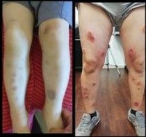 Two pictures of a person's legs before and after treatment.